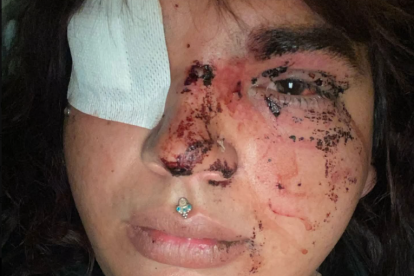 Las heridas que presenta Miss Trans Zamora,  Bianca Lizbeth Fernández, tras la agresión.