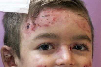 El pequeño Javi Gallo, de seis años, convive desde su nacimiento con la enfermedad conocida como piel de mariposa.