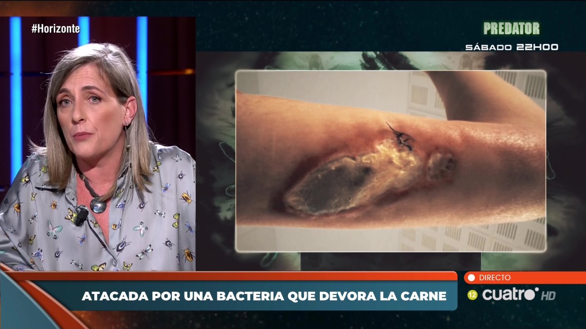 Imagen del brazo donde le salió la úlcera Buruli a la leonesa Patricia Casas. -X. I. J