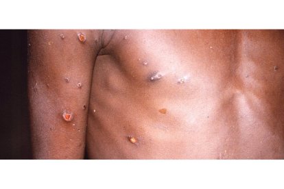 La viruela del mono produce lesiones cutáneas, fiebre y dolor corporal en las personas afectadas por el virus. EP
