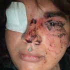 Las heridas que presenta Miss Trans Zamora,  Bianca Lizbeth Fernández, tras la agresión.