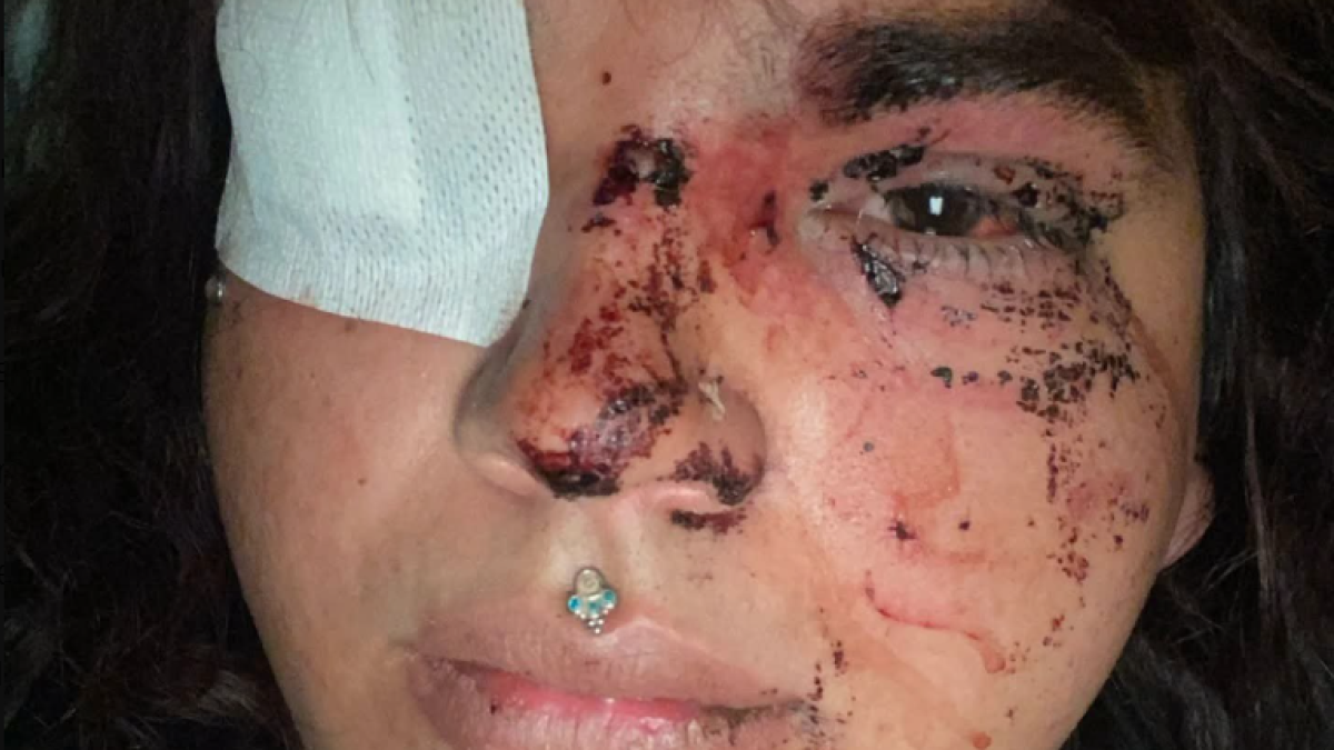 Las heridas que presenta Miss Trans Zamora, Bianca Lizbeth Fernández, tras la agresión.