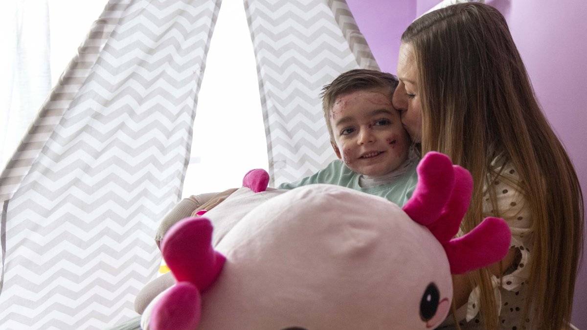 El pequeño Javi Gallo, de seis años, convive desde su nacimiento con la enfermedad conocida como piel de mariposa.